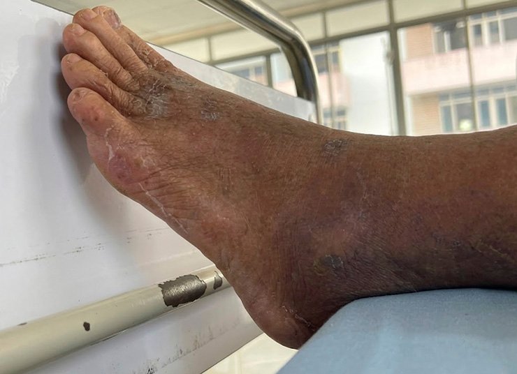 Protecting Your Feet From High Sugar